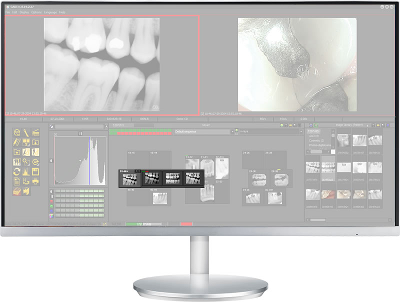 cadi xrays history